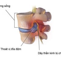 Hiện tượng thoát vị đĩa đệm có gây biến chứng nguy hiểm không?