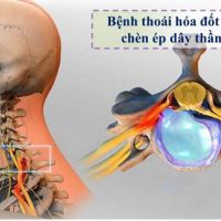 Bật mí nguyên nhân thoái hoá đốt sống cổ và giải pháp chưa trị tận gốc