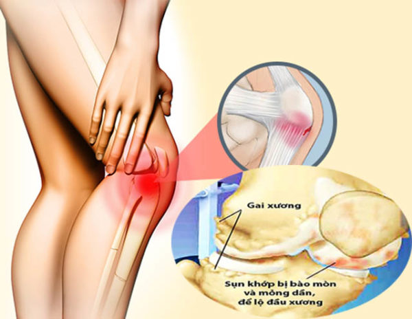 Bệnh gai gối có chữa được bằng đông y không?