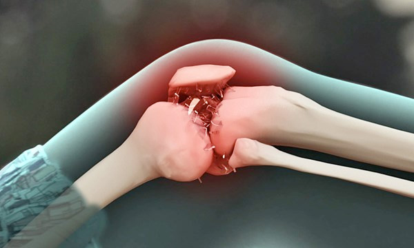 Điều trị gãy xương hở như thế nào?